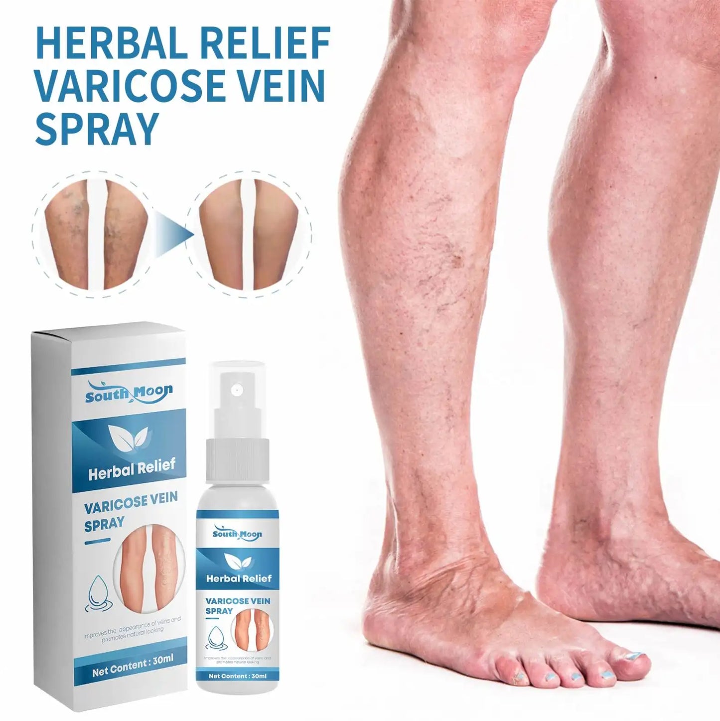 Tratamiento en Spray Varicose Veins + ENVIO GRATIS