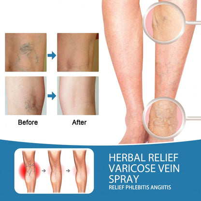 Tratamiento en Spray Varicose Veins + ENVIO GRATIS