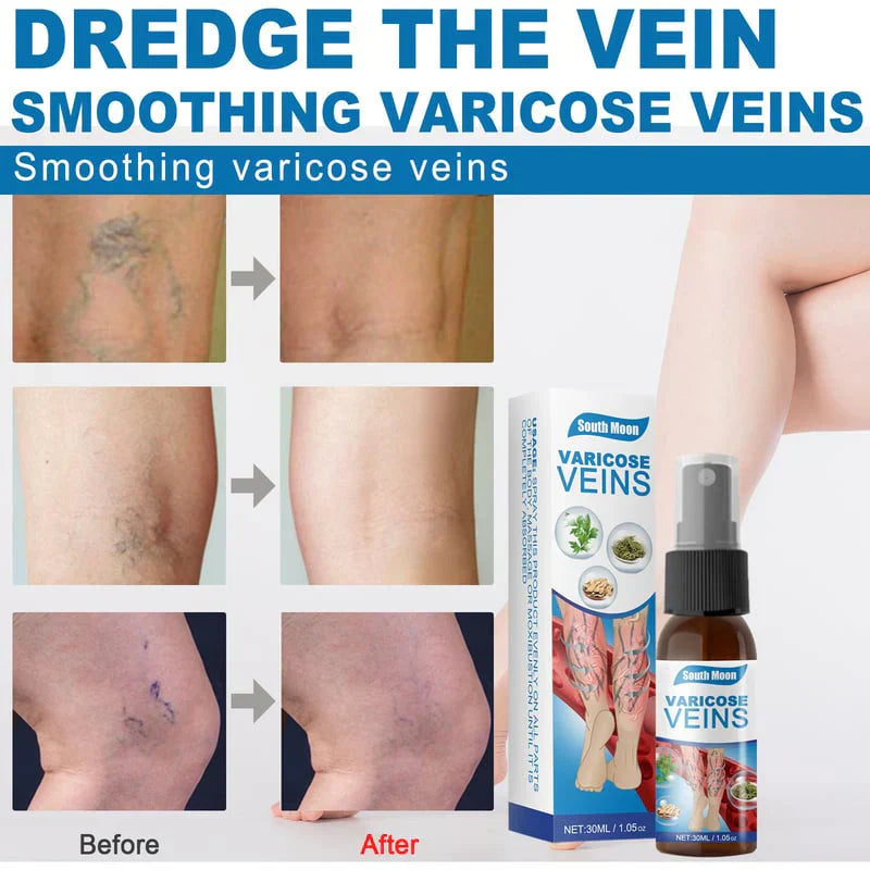 Tratamiento en Spray Varicose Veins + ENVIO GRATIS