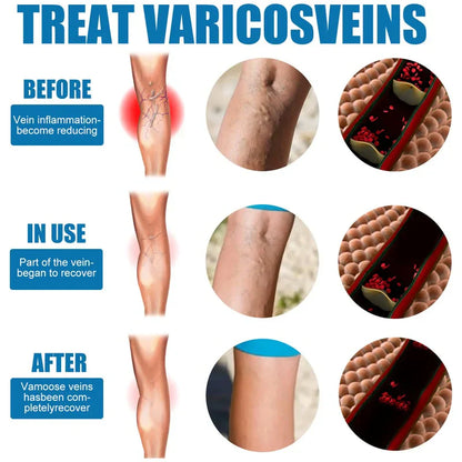 Tratamiento en Spray Varicose Veins + ENVIO GRATIS
